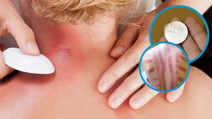 Nhiều người đau mỏi người, 'trúng gió' dùng đồ bạc, trứng gà cạo gió. (Ảnh minh họa)
