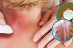 Vì sao đau mỏi người, 'trúng gió' dùng đồ bạc, trứng gà để cạo gió?