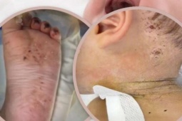 Chấn động vụ em bé 10 tháng tuổi nhập viện với 600 vết kim bị mẹ đâm để "chữa bệnh"