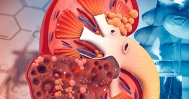 8 thói quen gây suy thận, người Việt cần biết để tránh