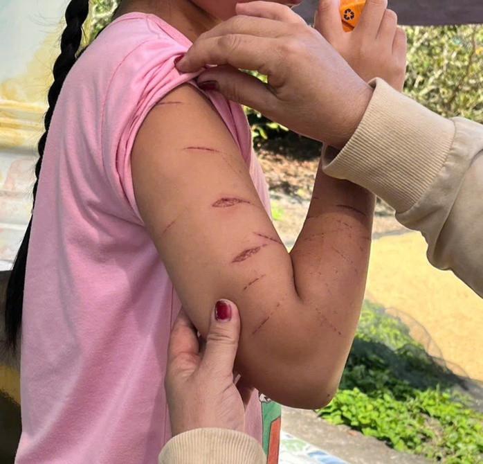 Vết thương trên cơ thể nữ sinh N.