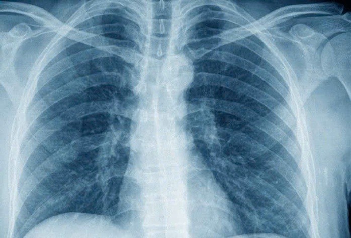 Quy định định mức thời gian chụp X-quang tối thiểu 6 phút gây khó khăn cho bệnh viện trong thanh toán BHYT, do nhiều ca bệnh đơn giản có thời gian thực hiện ngắn hơn.