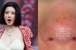 Nữ ca sĩ 31 tuổi bị bỏng nặng sau chuyến leo núi