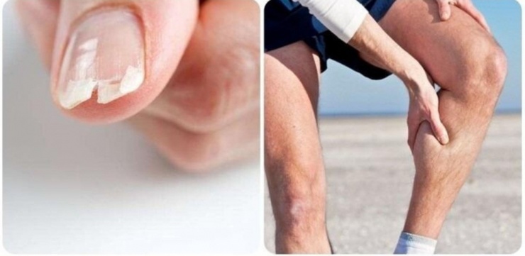 Dấu hiệu cảnh báo cơ thể đang thiếu canxi hay bị nhiều người bỏ qua. (Ảnh minh họa: VTC News)