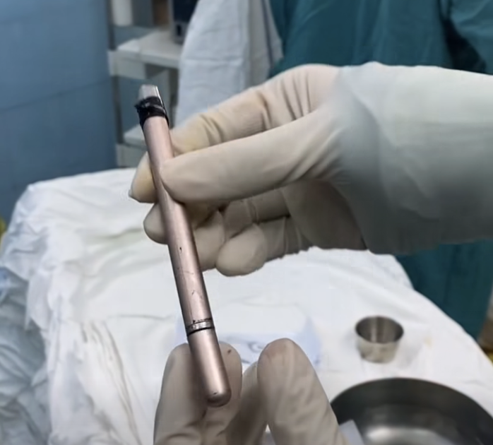 Dị vật là cây bút được bác sĩ lấy ra khỏi bàng quang của bệnh nhân