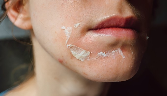 Peel da hóa học khiến da bong tróc, đỏ rát và tăng nhạy cảm với ánh nắng mặt trời.