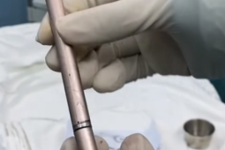 Thiếu nữ dùng cây bút gãi ngứa vùng kín rồi bị mắc kẹt trong bàng quang