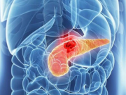Người đàn ông 45 tuổi phát hiện ung thư tuyến tụy từ dấu hiệu nhiều người Việt bỏ qua