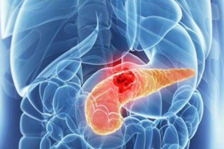 Người đàn ông 45 tuổi phát hiện ung thư tuyến tụy từ dấu hiệu nhiều người Việt bỏ qua