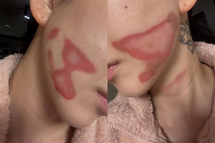 Gương mặt nữ ca sĩ bị bỏng nghiêm trọng.