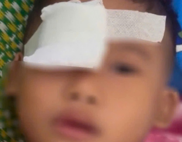 Em T.V.T (học sinh lớp 1) bị thương vùng mắt.