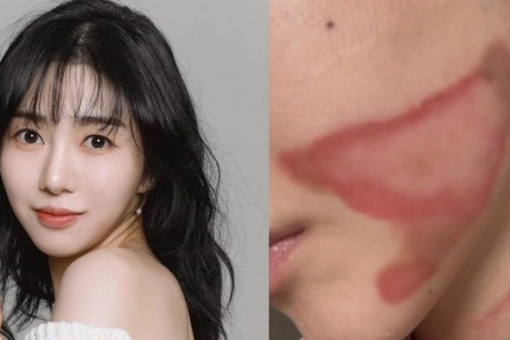 Gương mặt nữ ca sĩ 33 tuổi bị bỏng nghiêm trọng sau thẩm mỹ