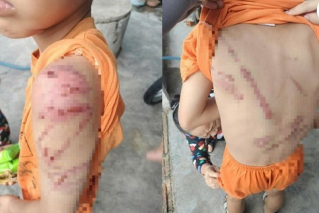 Xót xa hình ảnh cháu trai nghi bị cha đánh bầm tím khắp người