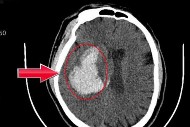 Người đàn ông 44 tuổi đang khỏe mạnh bất ngờ đột quỵ từ dấu hiệu nhiều người Việt mắc phải