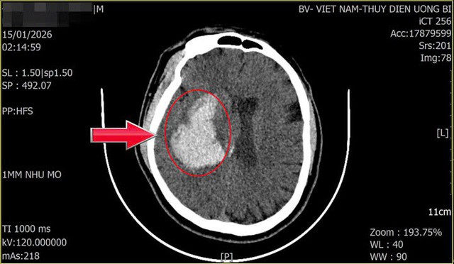 Khối máu tụ của người bệnh (vị trí mũi tên chỉ). Ảnh: BVCC