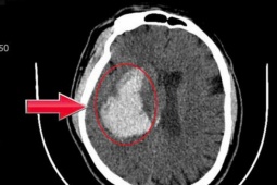 Người đàn ông 44 tuổi đang khỏe mạnh bất ngờ đột quỵ từ dấu hiệu nhiều người Việt mắc phải
