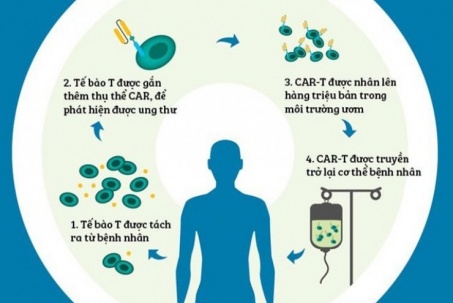 Liệu pháp CAR-T được dùng điều trị ung thư máu là gì?