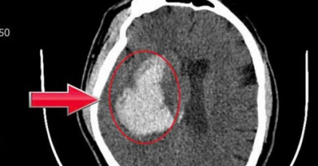 Người đàn ông 44 tuổi đang khỏe mạnh bất ngờ đột quỵ từ dấu hiệu nhiều người Việt mắc phải