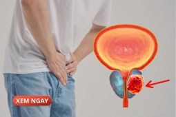 Tin tức sức khỏe - 5 đối tượng có khả năng cao mắc phì đại tuyến tiền liệt khi về già, nam giới chớ chủ quan