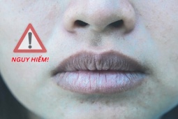 Tin tức sức khỏe - 3 dấu hiệu trên mặt cảnh báo phổi “gặp hạn”, đừng chậm trễ kẻo “tử thần gõ cửa”!