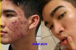 Tin tức sức khỏe - Đàn ông con trai bị mụn: Chấm dung dịch này mỗi tối là sạch sẽ, không cần đi Spa với bôi kem như con gái
