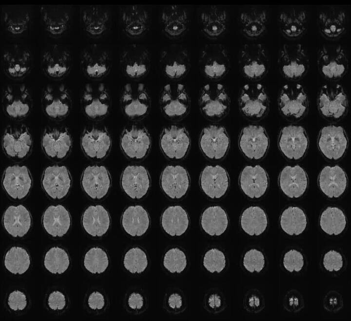 Chụp cộng hưởng từ chức năng (fMRI) là một kỹ thuật không xâm lấn dùng để đo hoạt động của não. (Ảnh: CNN)