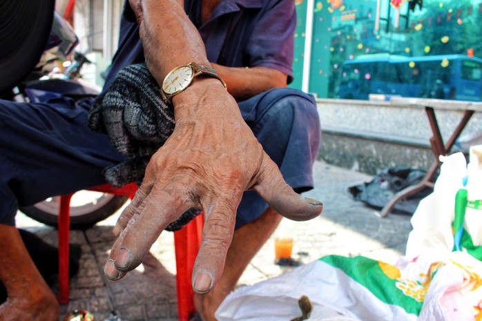 Những ngón tay cong quẹo, chai sần của ông Tiến gần như không còn cảm giác đau.