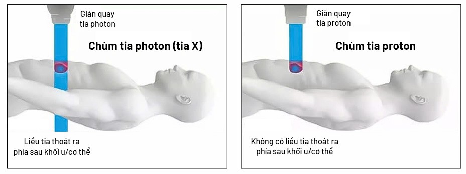 Xạ trị Proton hiện đại với tia năng lượng biết “dừng đúng chỗ” ngay vị trí khối u để tiêu diệt khối u hiệu quả và an toàn cao.