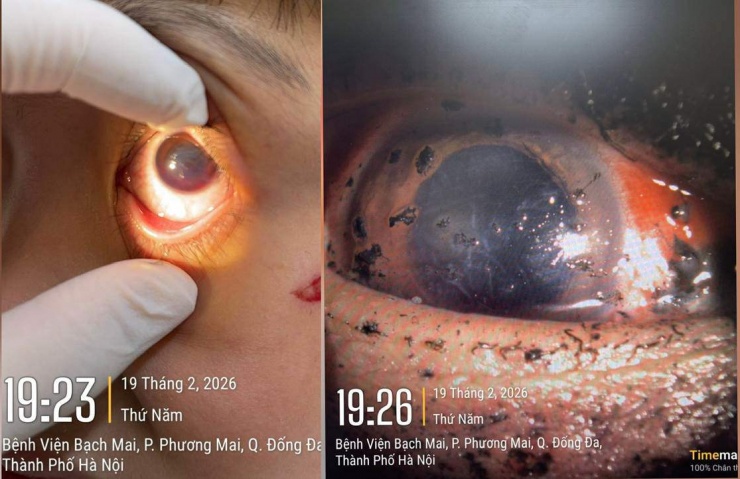 Mắt bị tổn thương do pháo nổ. Ảnh: BVCC
