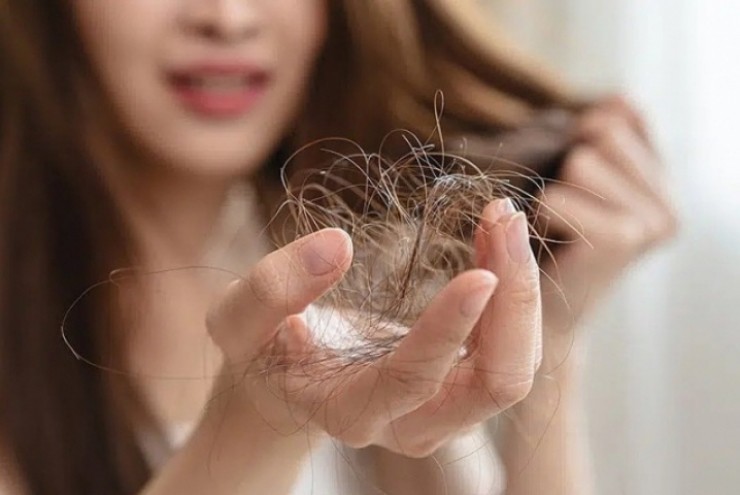 4 nguyên nhân phổ biến khiến vuốt nhẹ tóc cũng rụng cả nắm