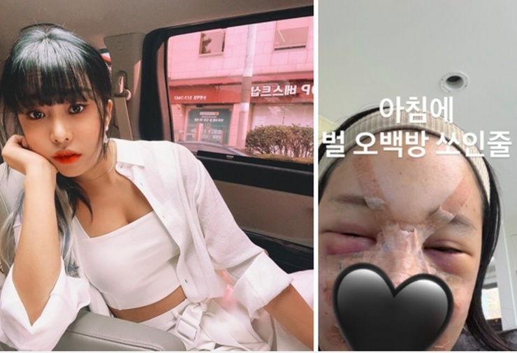 MC xứ Hàn RalRal chia sẻ hình ảnh gương mặt sưng phù sau dao kéo dấy lên nhiều lo ngại. IG.