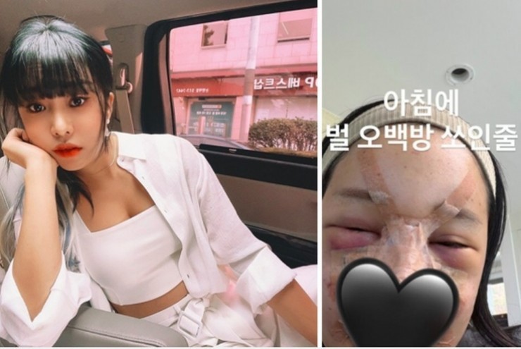 Lời cảnh báo sau vụ MC xinh đẹp sưng vù mặt mũi vì phẫu thuật làm đẹp đón Tết