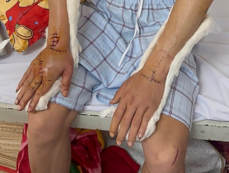 Nạn nhân bị chém vào đầu và hai tay