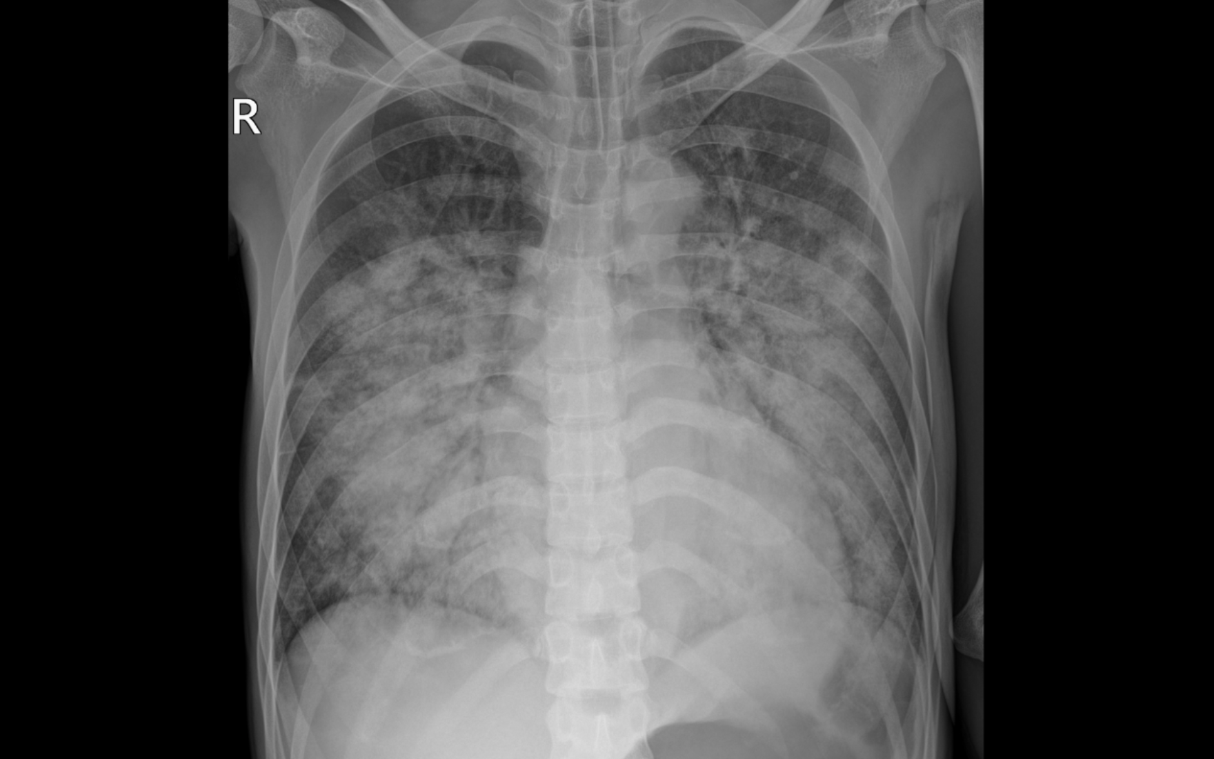 Phim chụp X quang thể hiện tổn thương mờ, lan tỏa 2 phổi của bệnh nhân