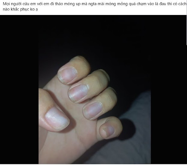 Một trường hợp móng bị mài mỏng khiến móng trở nên nhạy cảm, đau buốt.