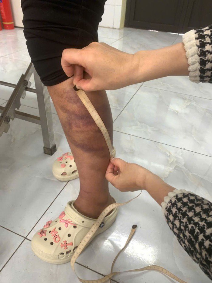 Vết bầm tím trên chân cháu M. do bị bố đánh
