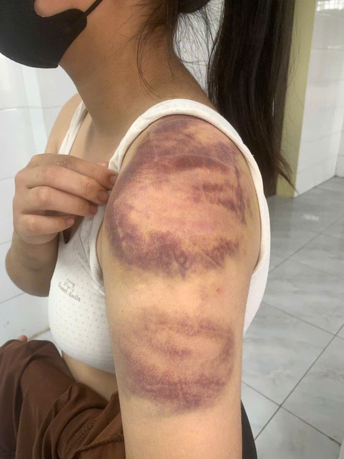 Những vết thương trên người cháu M. do bố đánh đập