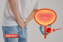 Tin tức sức khỏe - 5 đối tượng có khả năng cao mắc phì đại tuyến tiền liệt khi về già, nam giới chớ chủ quan