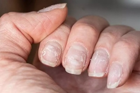 'Kiếp nạn' tháo nails giả sau Tết và những điều cần lưu ý để bớt hại móng