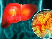 Một thói quen ăn uống quen thuộc có thể làm tăng nguy cơ ung thư gan, người Việt nên tránh