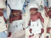 Sản phụ 24 tuổi sinh 5 con sau thụ thai tự nhiên