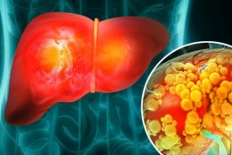 Một thói quen ăn uống quen thuộc có thể làm tăng nguy cơ ung thư gan, người Việt nên tránh