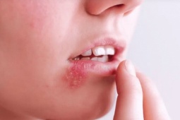 Người phụ nữ 30 tuổi chết não vì chủ quan với mụn rộp khóe miệng