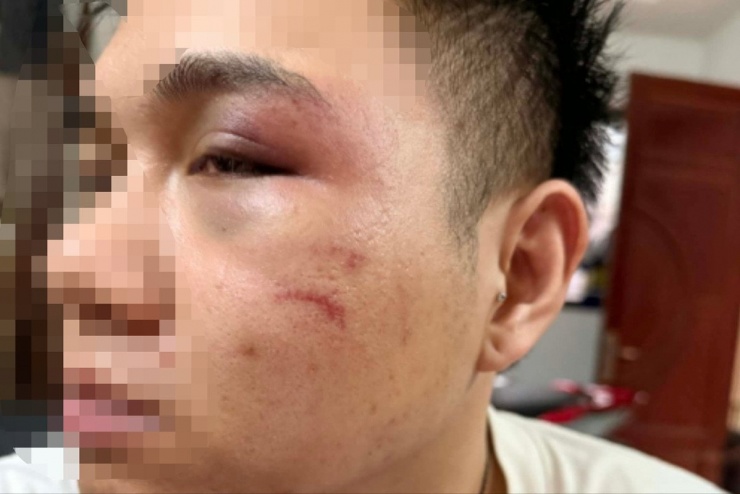 Mặt anh Ph. bị sưng. Ảnh: Nhân vật cung cấp.