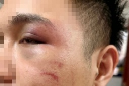 Hà Nội: Từ chối chở khách say xỉn, tài xế xe công nghệ bị đánh sưng mặt