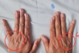 Tê ngón tay út tưởng chuyện nhỏ, người đàn ông suýt teo cả bàn tay