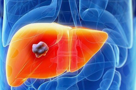 Người đàn ông 44 tuổi phát hiện ung thư gan sau khi xét nghiệm men gan tăng cao: Có 1 thói quen nhiều người Việt mắc phải