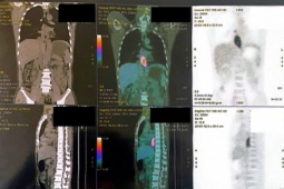 Nuốt nghẹn, sụt 5 kg, đi khám phát hiện mắc hai loại ung thư