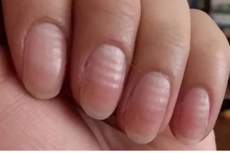 5 dấu hiệu trên móng tay cảnh báo vấn đề sức khỏe nghiêm trọng lại hay bị ngó lơ