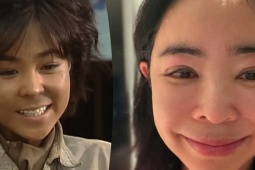  ' Nàng Quạ '  Lee Hye Young mắt sưng húp sau điều trị ung thư